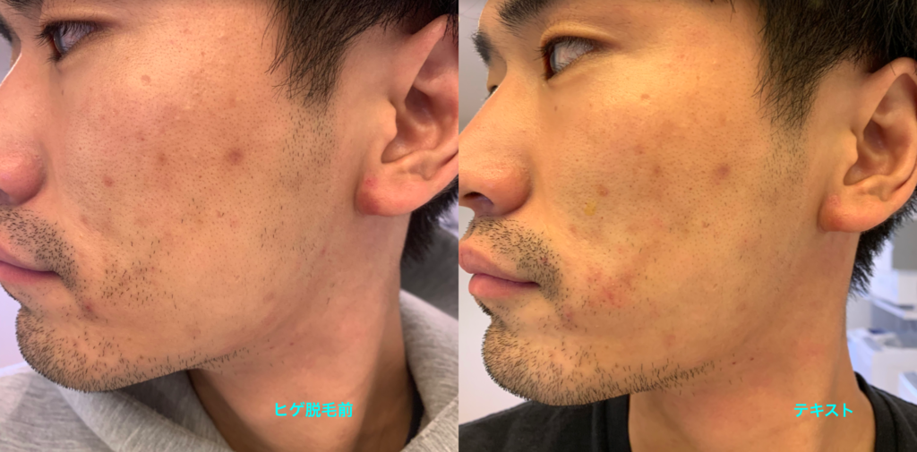 髭脱毛後の髭は剃りにくい しっかり剃れる髭剃りテク5選を解説 ヒゲ脱毛は痛いの おすすめクリニックと効果を比較 Datsuo